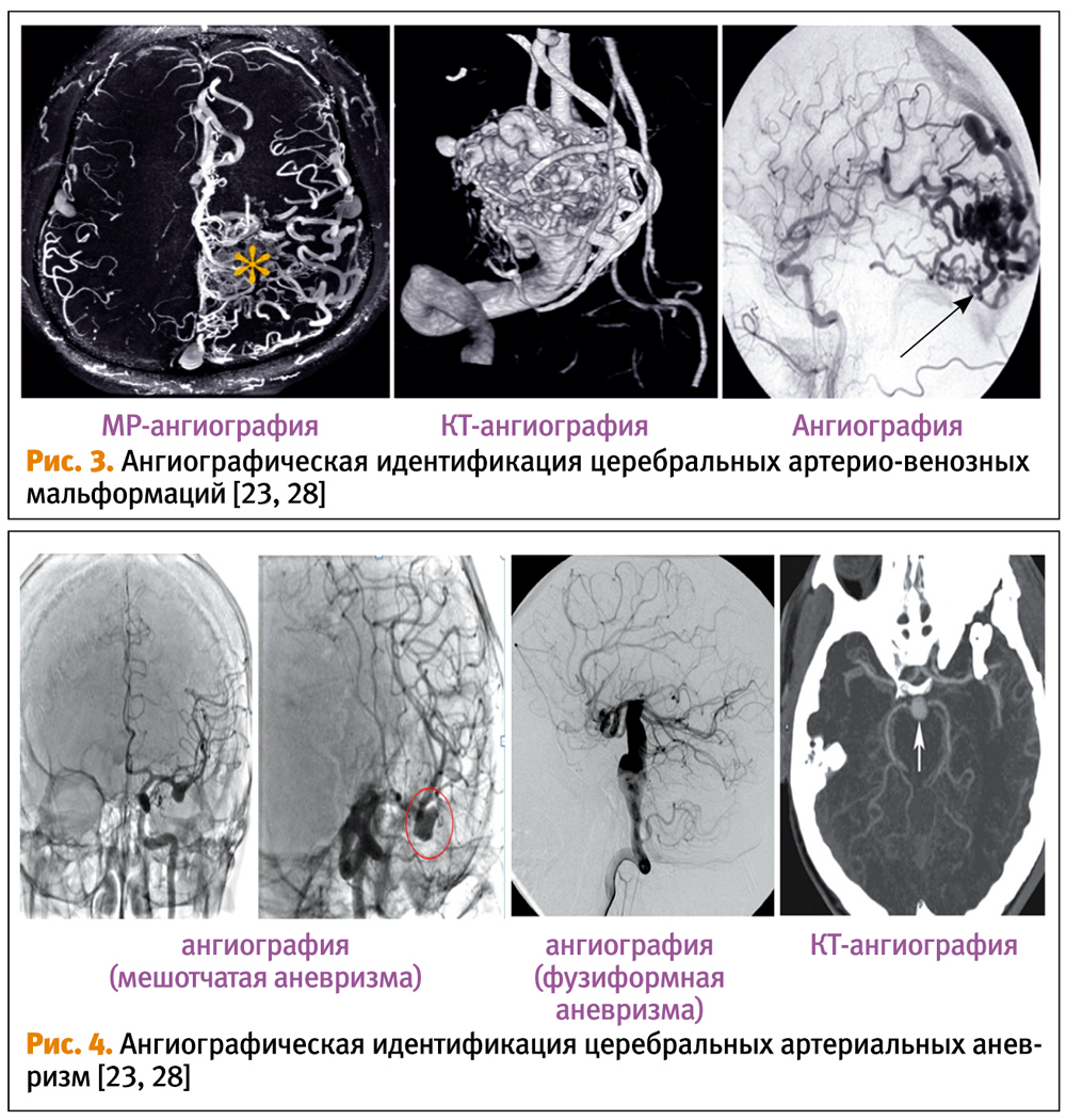 Артериальные аневризмы и артерио-венозные мальформации сосудов головного  мозга во время беременности — Extempore