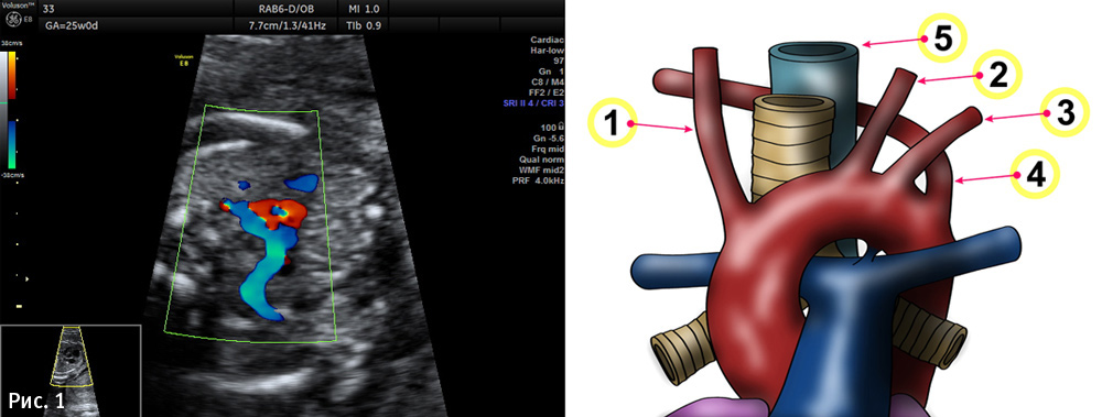 Правая аберрантная артерия. Аберрантная правая подключичная артерия кт. Аберрантная левая подключичная артерия. Правая аберрантная подключичная артерия на УЗИ. Левая аберрантная подключичная артерия у плода.