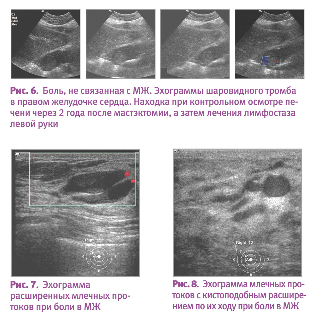 Папиллома протоков молочной железы